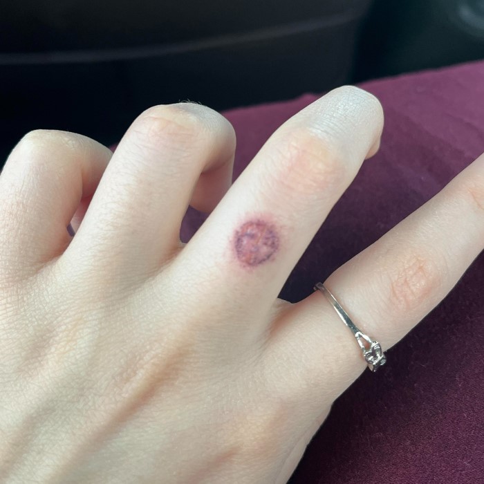 what does ink poisoning look like